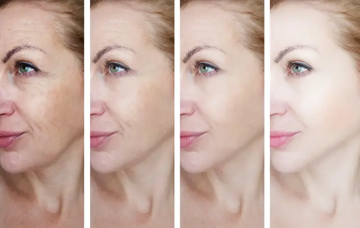 Image of a woman before and after using Derma Micro Tone